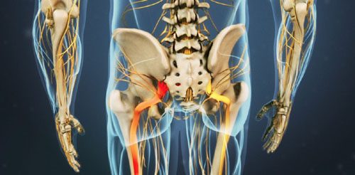 Sciatic Pain