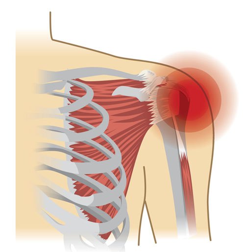 Shoulder Pain